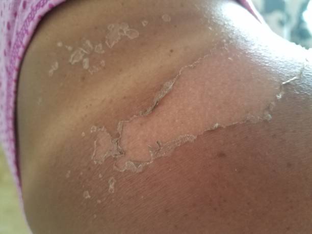 istock a sun burn and peeling skin on a woman's shoulder 841571068