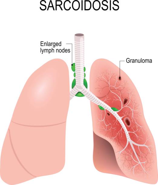 Sarcoidosis. lungs with granulomas Sarcoidosis. Human's lungs with granulomas and Enlarged lymph nodes erythema nodosum stock illustrations