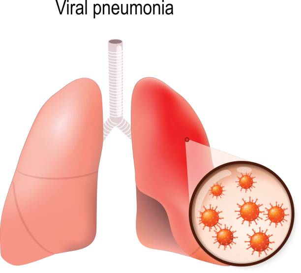 illustrazioni stock, clip art, cartoni animati e icone di tendenza di polmonite virale - citomegalovirus