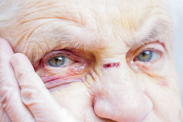 istock Injured elderly woman's eyes & face 841776396