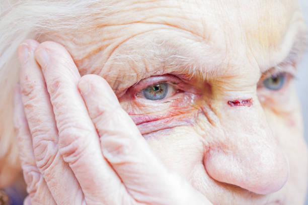 istock Injured elderly woman's eyes & face 841791406