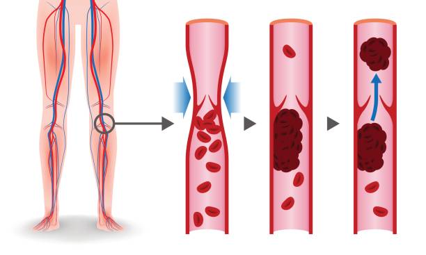 economy-class-syndrom mechanismus, tiefen venen thrombosis(dvt), pulmonalen embolism(pe) kranzartigen thrombosis, abbildung diagramm - vene stock-grafiken, -clipart, -cartoons und -symbole