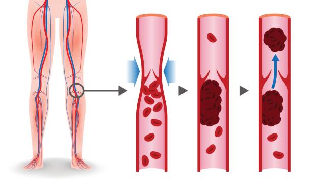 이코노미 클래스 증후군 메커니즘, 깊은 정 맥 thrombosis(dvt), 폐 embolism(pe), 관상 혈전 증, 일러스트 레이 션 다이어그램 - human vein stock illustrations