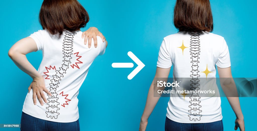 chiropractic before after image. from bad posture to good posture. woman's body and backbone. Scoliosis Stock Photo