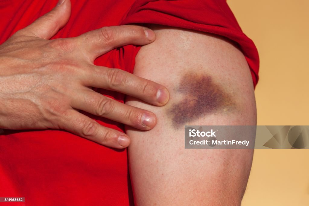 Wounded male hand. Big bruise on the male hands. Painful accident. Left arm injured. Wounded male hand. Big bruise on the male hands. Painful accident. Left arm injured Bruise Stock Photo