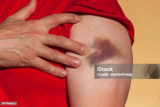 Wounded Male Hand Big Bruise On The Male Hands Painful Accident Left Arm Injured Stock Photo - Download Image Now