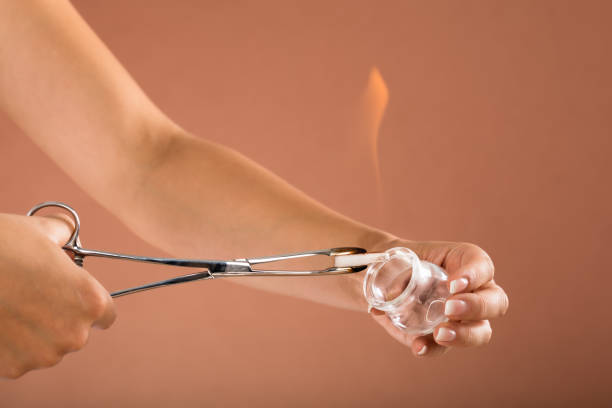 Therapist Holding Lit Camphor With Tong And Cup Close-up Of A Therapist Holding Lit Camphor With Tong And Cup In Spa cupping therapy stock pictures, royalty-free photos & images