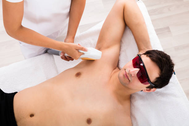 Therapist Giving Laser Epilation Treatment On Man's Armpit High Angle View Of A Therapist Giving Laser Epilation Treatment On Man's Armpit body hair stock pictures, royalty-free photos & images