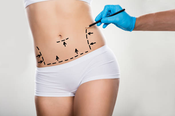 chirurgo che disegna linee di correzione sullo stomaco della donna - liposuction foto e immagini stock
