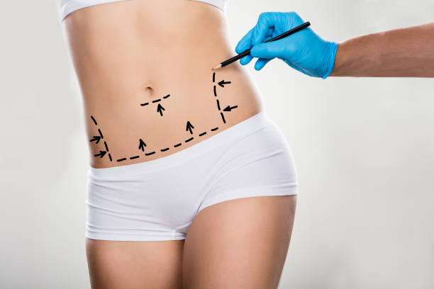 surgeon drawing correction lines on woman's stomach - liposuction imagens e fotografias de stock