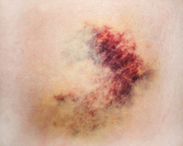Bruise on skin Bruise on white skin. Close-up photo hematoma images stock pictures, royalty-free photos & images