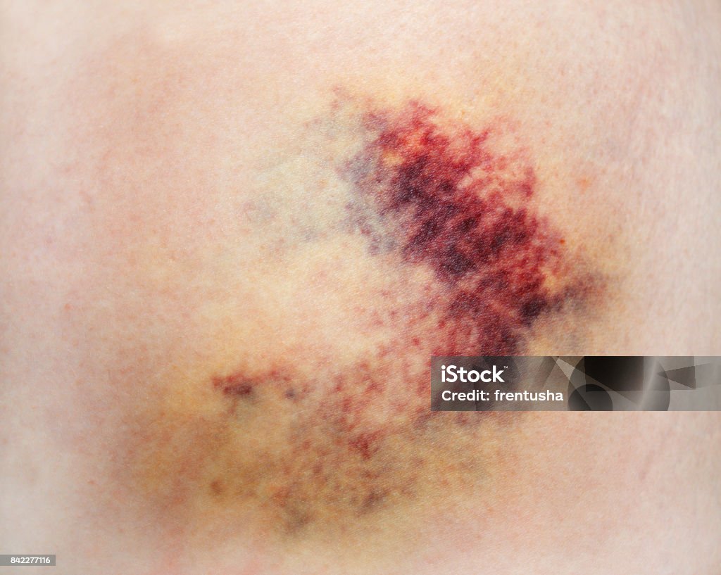 Vết Bầm Tím Trên Da Hình ảnh Sẵn có - Tải xuống Hình ảnh Ngay bây ...