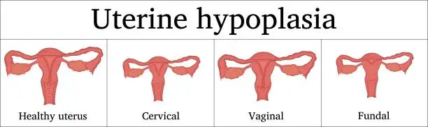 Vector illustration of Illustration of Uterine hypoplasia