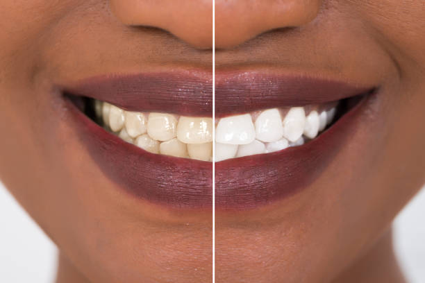 dientes de la mujer antes y después de blanqueamiento - blanqueamiento dental fotografías e imágenes de stock