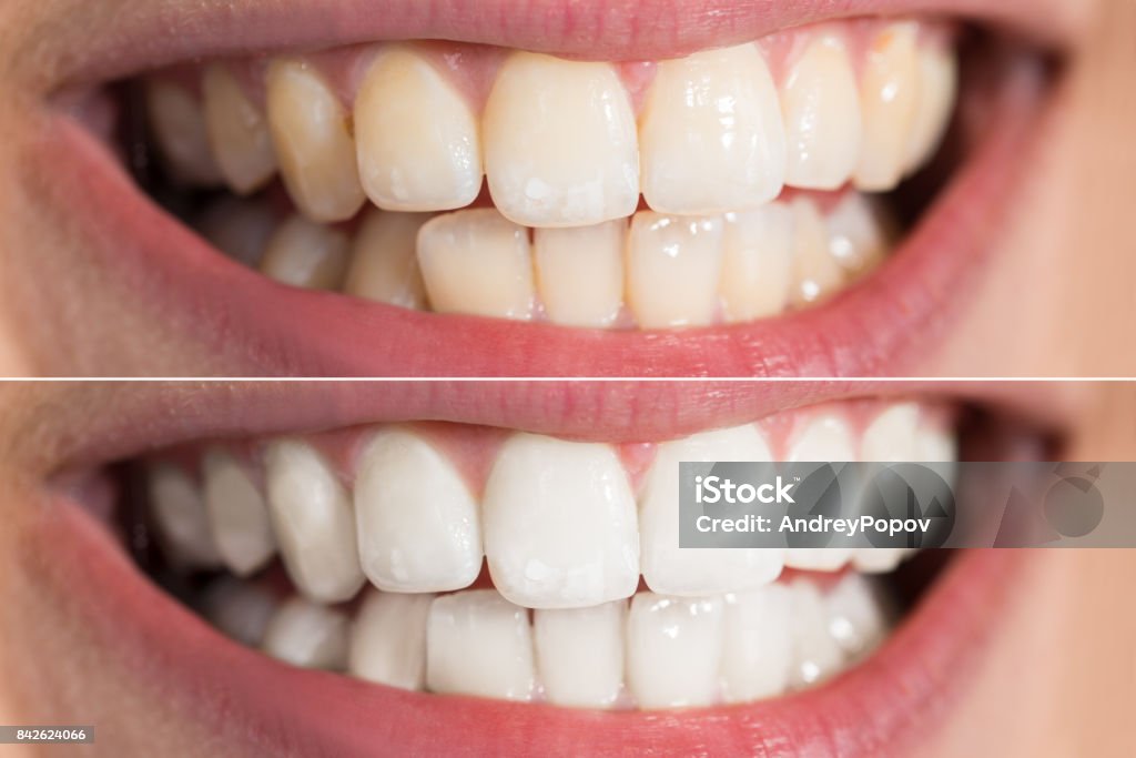 Person Zähne vor und nach der Aufhellung - Lizenzfrei Zahnaufhellung Stock-Foto