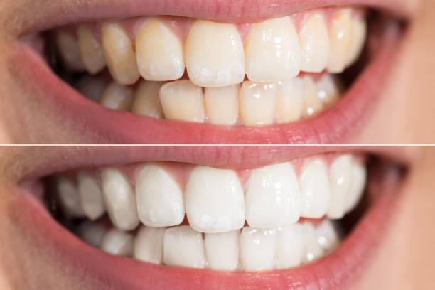istock Person Teeth Before And After Whitening 842624066