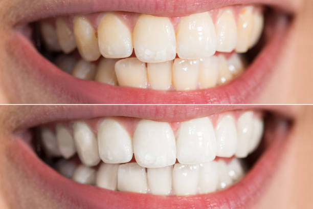 Person Teeth Before And After Whitening Close-up Detail Of Person Teeth Showing Before And After Whitening tooth whitening photos stock pictures, royalty-free photos & images