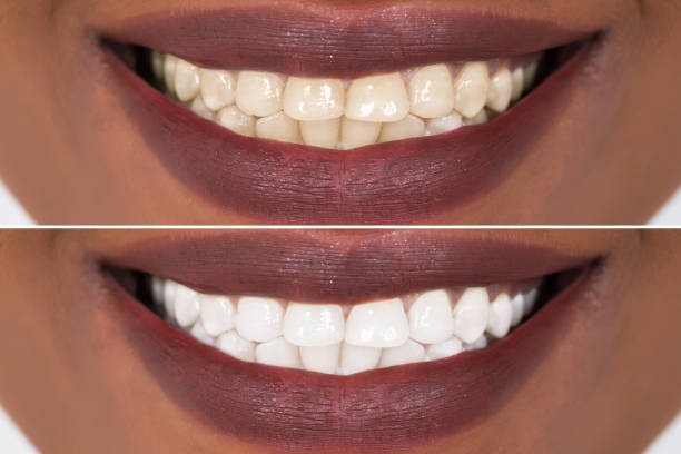 istock Woman Teeth Before And After Whitening 842624072