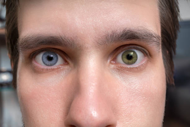 istock Young man with heterochromia - two different colored eyes. Contact lenses. 842772180