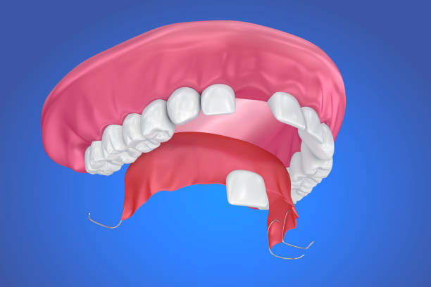 Single Missing Tooth - Removable partial denture .  3D illustration Single Missing Tooth - Removable partial denture .  3D illustration boreray and stac lee stock pictures, royalty-free photos & images