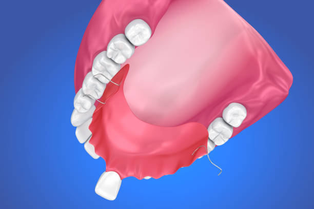 Single Missing Tooth - Removable partial denture .  3D illustration Single Missing Tooth - Removable partial denture .  3D illustration boreray and stac lee stock pictures, royalty-free photos & images
