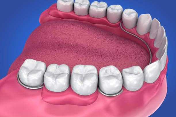 Removable partial denture. Medically accurate 3D illustration Removable partial denture. Medically accurate 3D illustration boreray and stac lee stock pictures, royalty-free photos & images