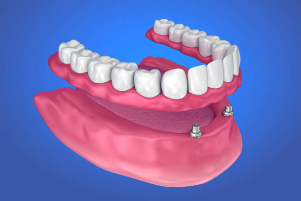 Overdenture to be seated on ball attachments. 3D illustration Overdenture to be seated on ball attachments. 3D illustration boreray and stac lee stock pictures, royalty-free photos & images