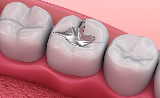 Empastes dentales de Metall, médicamente exacta Ilustración 3D photo