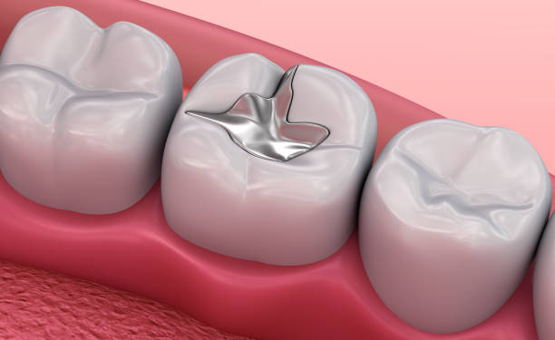 produits d’obturation dentaires metall, illustration 3d médicalement exacte - alliage photos et images de collection