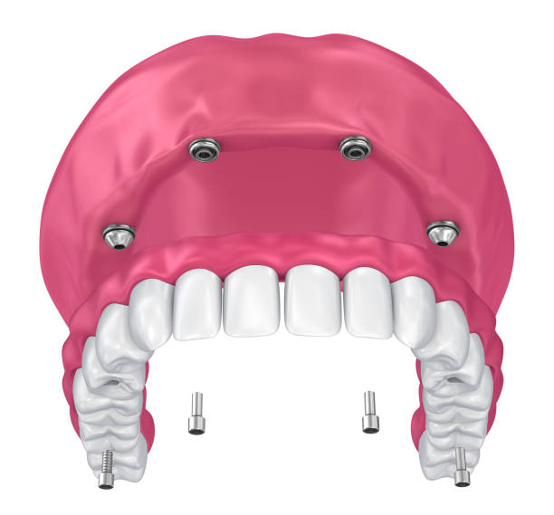 Overdenture to be seated on implants attachments. 3D illustration Overdenture to be seated on implants attachments. 3D illustration boreray and stac lee stock pictures, royalty-free photos & images