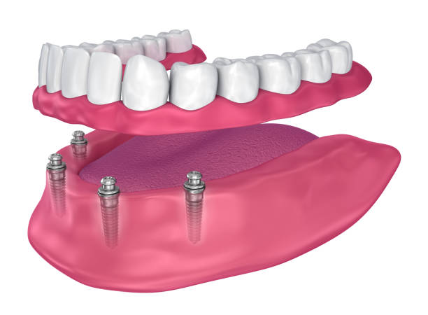 Overdenture to be seated on implants - ball attachments. 3D illustration Overdenture to be seated on implants - ball attachments. 3D illustration boreray and stac lee stock pictures, royalty-free photos & images