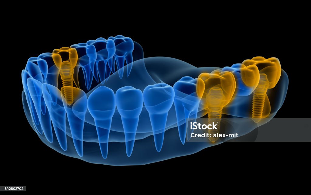 X-ray weergave van gebit met implantaten.  Xray weergave. Medisch nauwkeurige 3D illustratie - Royalty-free Tandimplantaat Stockfoto