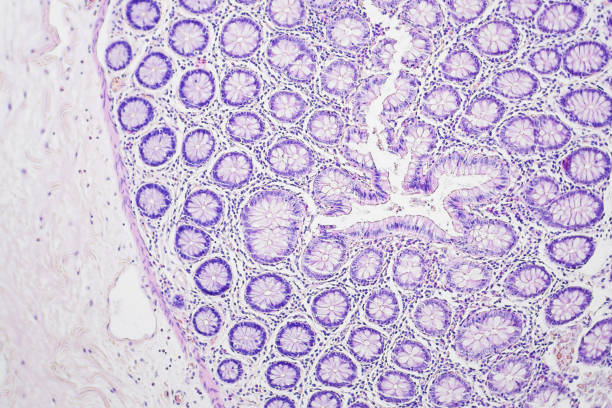 istock Colon cancer microscopic photography, magnification x100 842837626