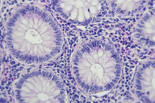 大腸癌の顕微鏡写真、倍率 x400 - blood cell blood red blood cell microscope ストックフォトと画像