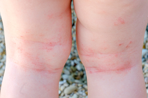 piel irritación closeup recién nacido dermatitis atópica piernas arañazos photo