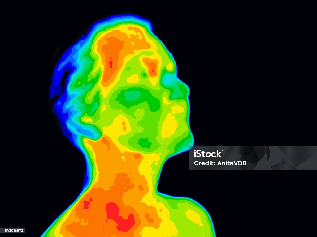 Face Thermograpy Carotid Thermographic image of a human face and neck showing different temperatures in a range of colors from blue cold to red hot. Red in the neck might indicate raised CR-P levels, this could be a sign of inflammation, and Carotid Artery inflammation which could be linked to a stroke. Thermal Image Stock Photo