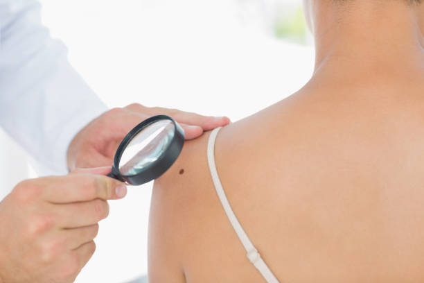 istock Doctor examining melanoma on woman 843205848