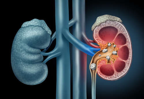 Human Kidney stones medical concept as an organ with painful crystaline mineral formations as a medicine symbol with a cross section with 3D illustration elements.