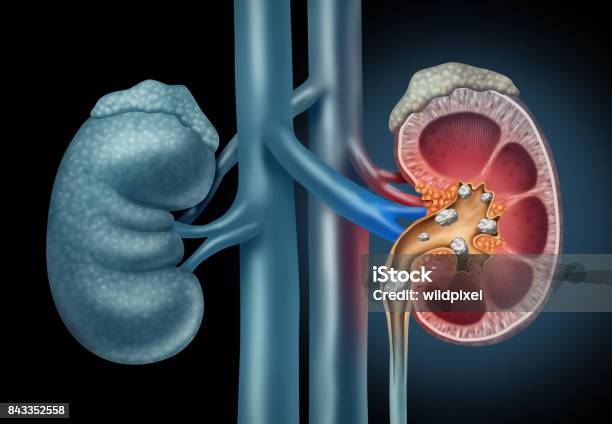 Human Kidney Stones Medical Concept Stock Photo - Download Image Now - Kidney Stone, Kidney - Organ, Pain