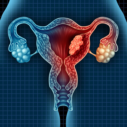 Uterus cancer and endometrial malignant tumor as a uterine medical concept as dangerous growing cells in a female body attacking the reproductive system as a symbol of cervical disease treatment diagnosis and symptoms with 3D illustration elements.