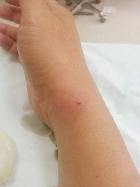 istock Lesion from injection because wrist tendon inflammation 843557812