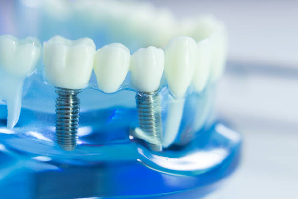 istock Dental teeth, mouth, gums dentists teaching model 843677680