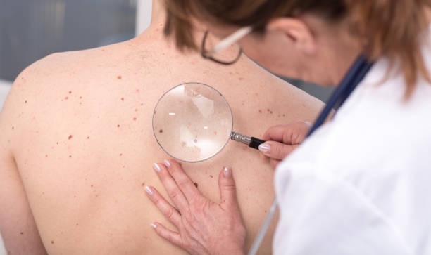 dermatolog badający skórę pacjenta - melanoma mole human skin dermatology zdjęcia i obrazy z banku zdjęć