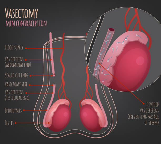 Man vasectomy image Man vasectomy image. Contraception concept. Male reproductive organs with useful information. Testis, scrotum and vessels. Vector illustration isolated on a dark grey background. phallic object stock illustrations