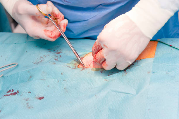 cierre de herida quirúrgica en el abdomen de un paciente del cirujano - sewing stitches thread surgery fotografías e imágenes de stock