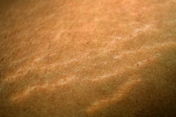 istock Stretch marks on the skin. Scars on the body. Stretch marks on legs. Cellulite. 845341290