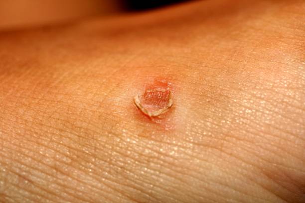 istock Corn on the skin. The corn popped. 845341308