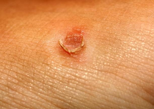 istock Corn on the skin. The corn popped. 845342040