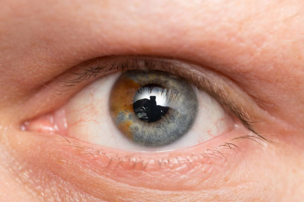 istock eyes of a man with a birthmark. macro 845523338