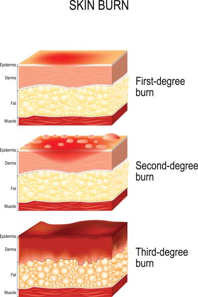 ilustraciones, imágenes clip art, dibujos animados e iconos de stock de quemaduras en la piel - second skin